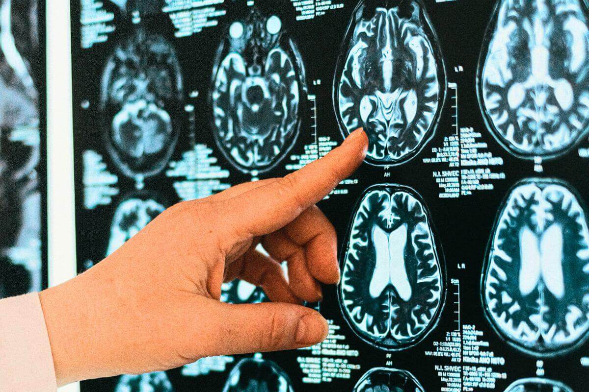 Behandling af tidlig multipel sklerose med D-vitamin – MT Health GmbH