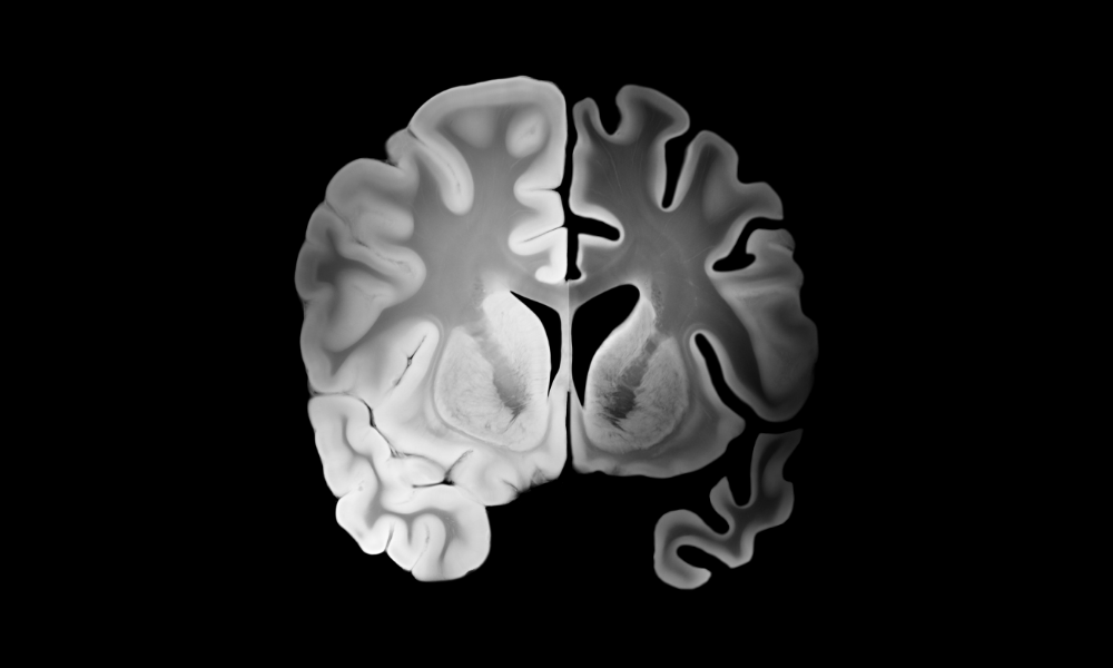 Kan livsstil beskytte hjernen mod Alzheimers?