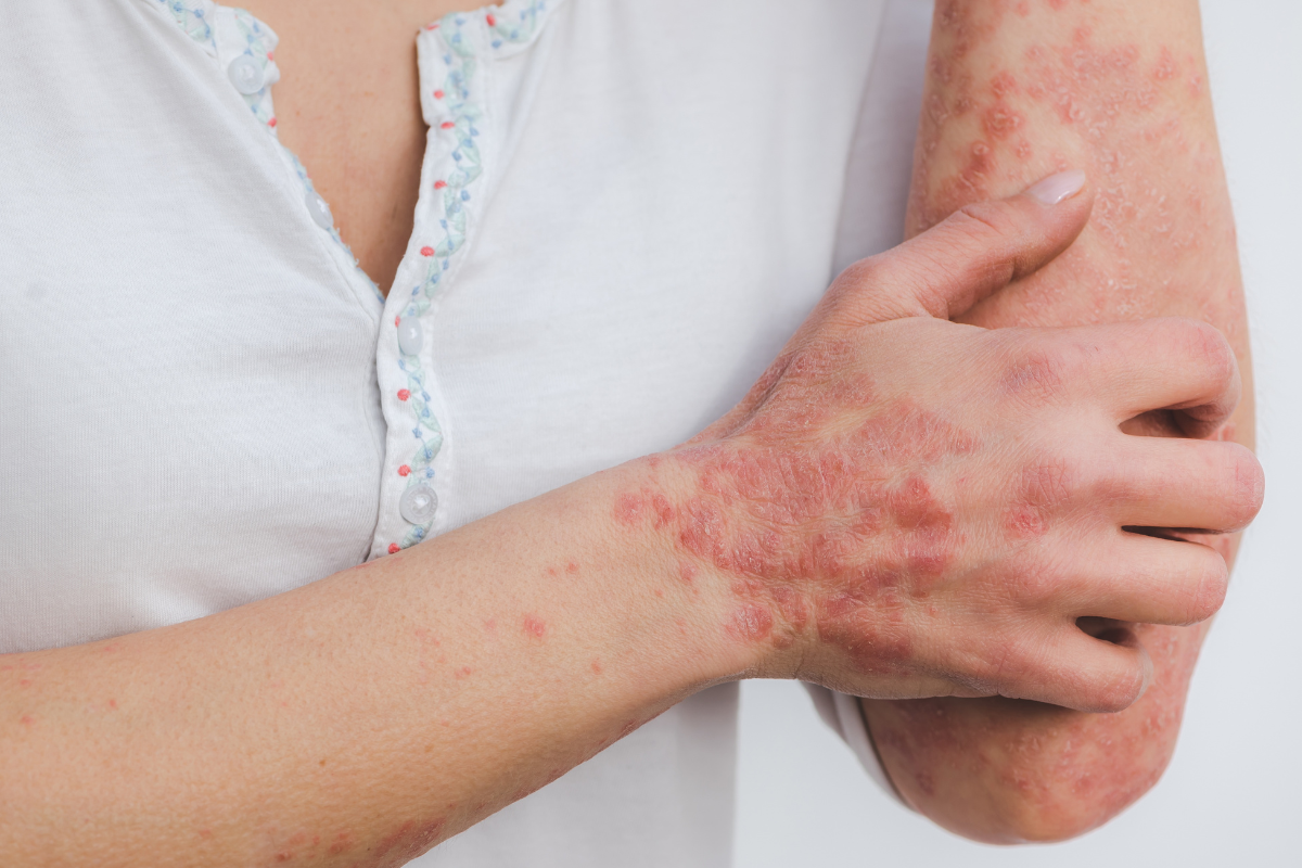 Psoriasis og kost: Kan tarmbakterier hjælpe på behandlingen?