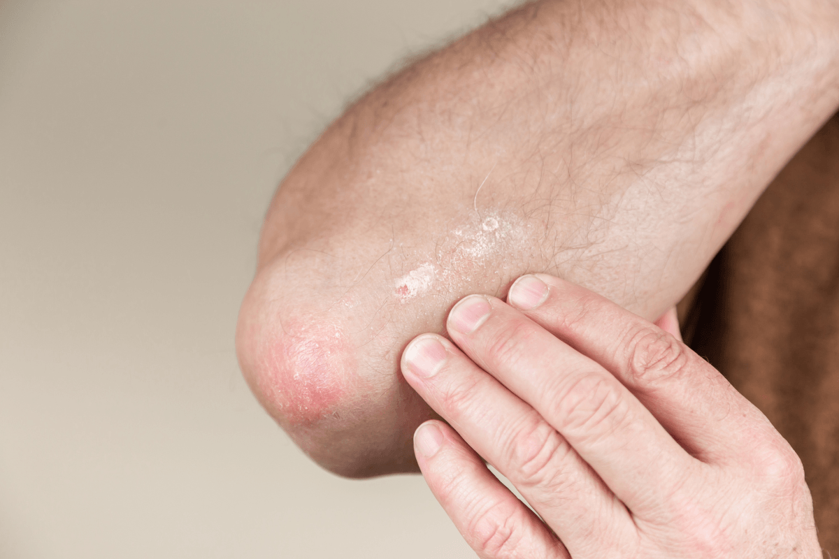 Middelhavskost og psoriasis: Kan kosten dæmpe symptomerne?