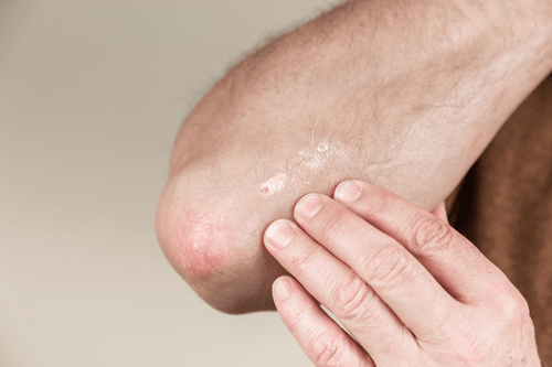 Middelhavskost og psoriasis: Kan kosten dæmpe symptomerne?